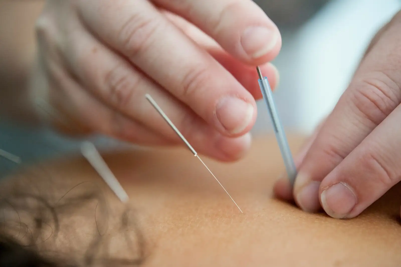 Acupuncture & Cupping