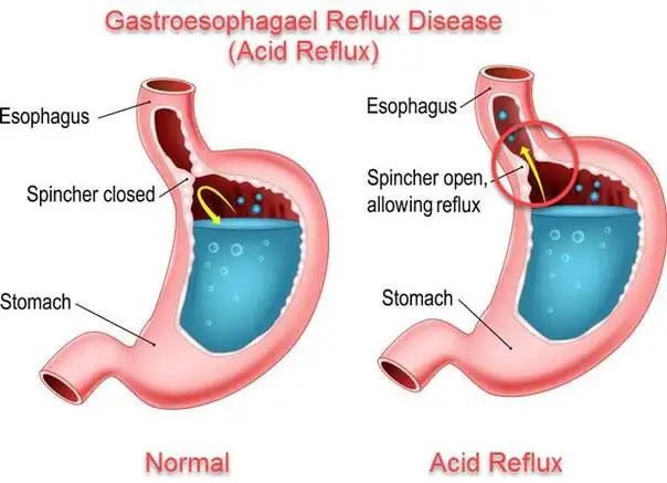 Heal Your Heartburn Naturally