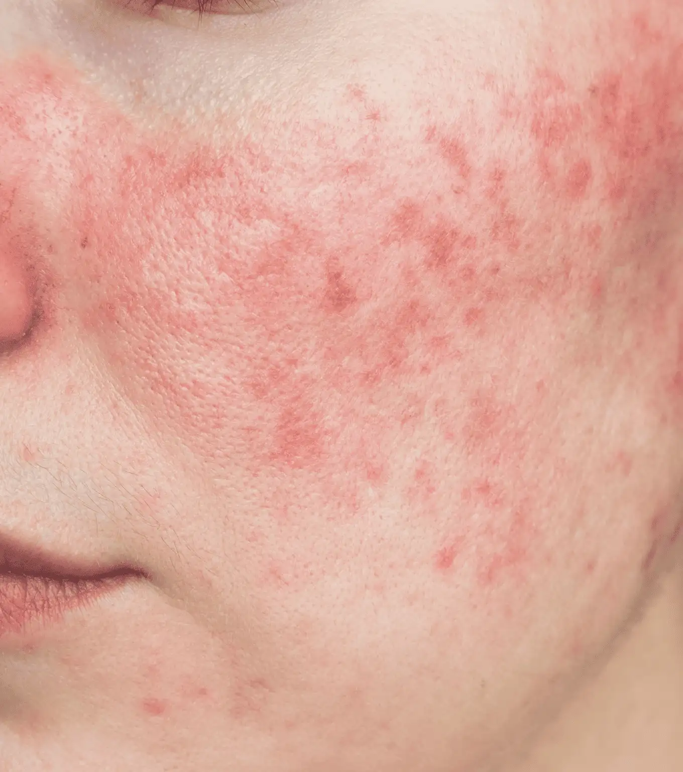 Rosacea