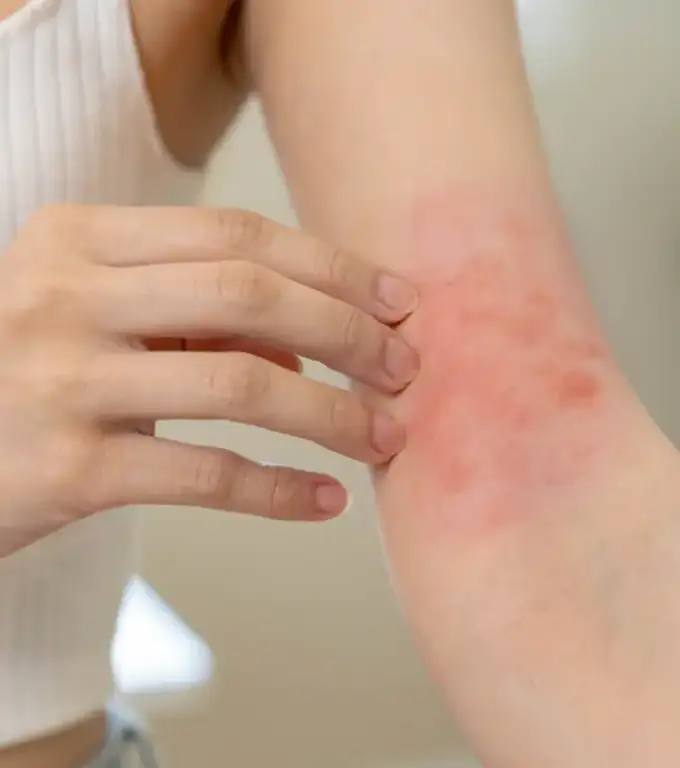 Eczema