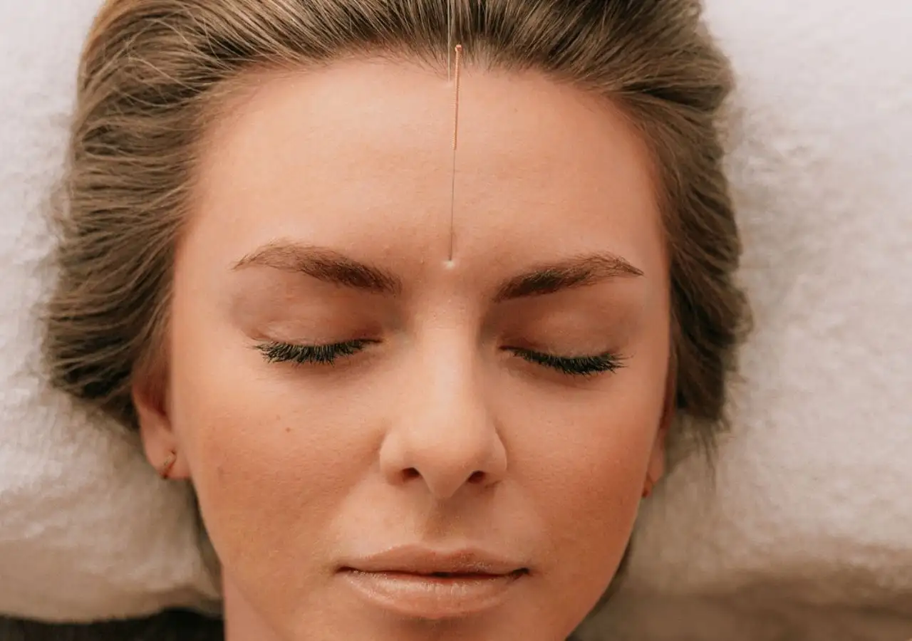 Facial Acupuncture