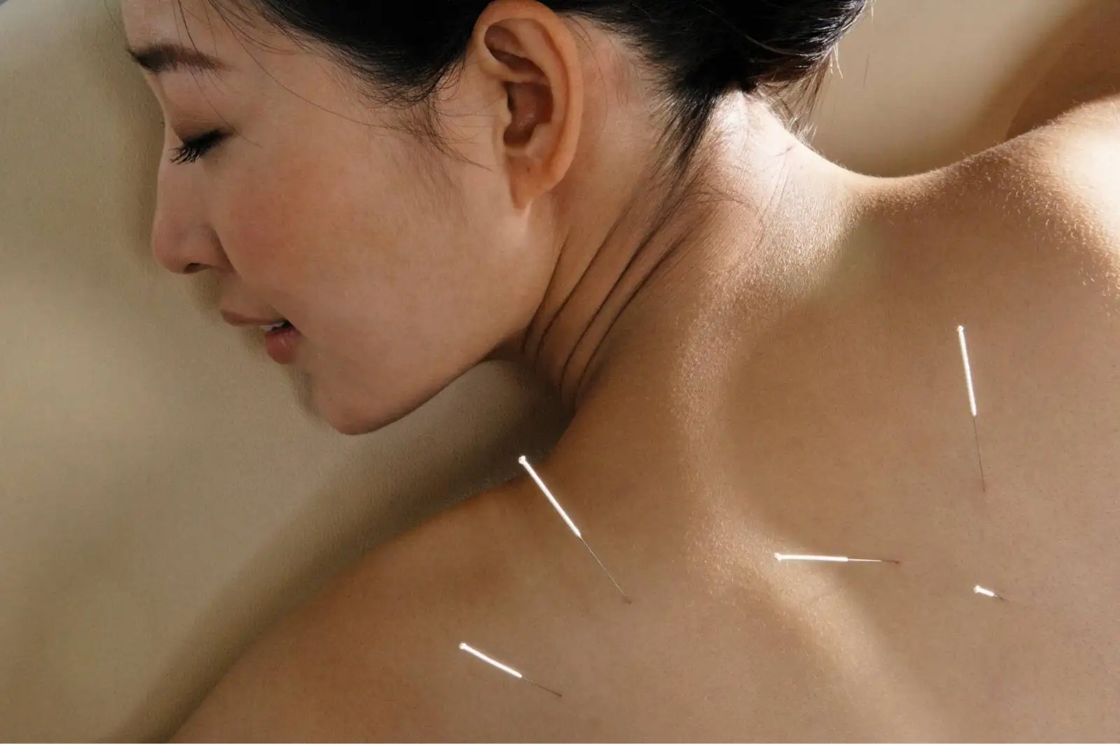 Registered Acupuncturist in Maple & Markham